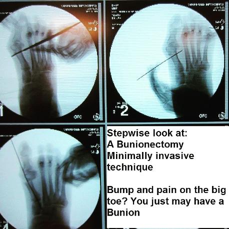 minimally invasive bunion surgery