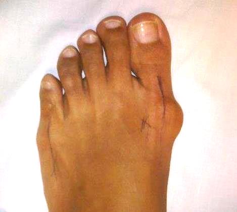 scarless bunion surgery