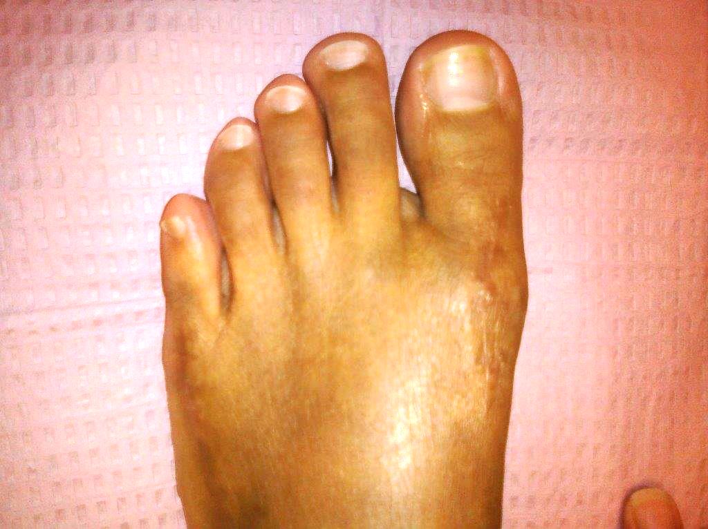 scarless bunion surgery