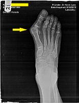 FFLC bunion surgery