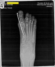 FFLC bunion surgery