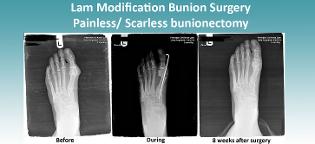scarless bunion surgery 