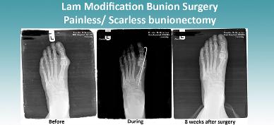 Lam modified no scar bunion surgery