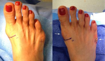 scarless bunion surgery