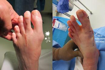 Bunion before and after surgery