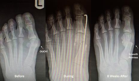 bunion surgery