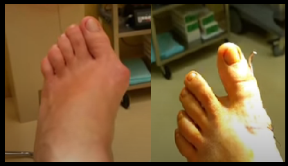 bunion surgery dr kevin lam before and after 