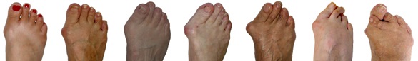 Minimally Invasive Bunion Surgery