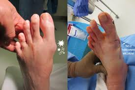 what to expect after bunion surgery