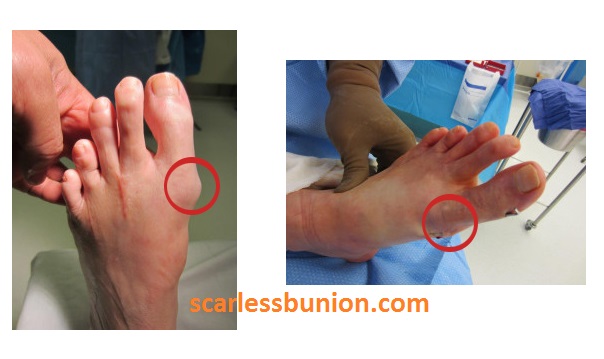 no scar bunion surgery