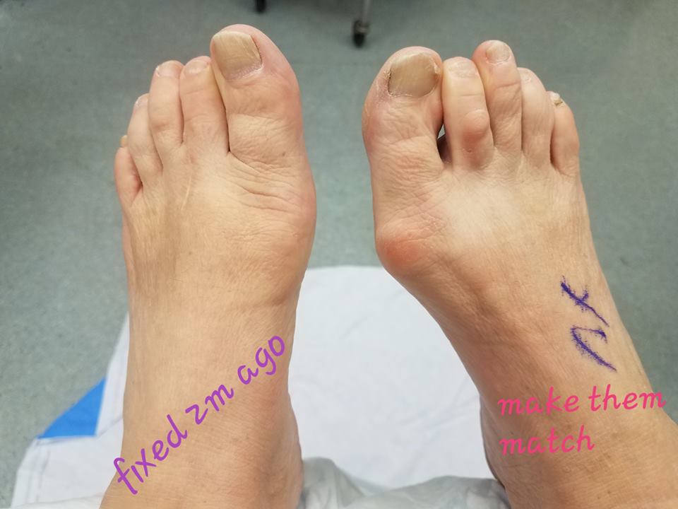 lam scarless bunion surgery