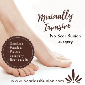 no scar bunionectomy